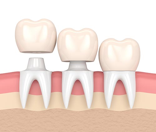 dental crown in epping