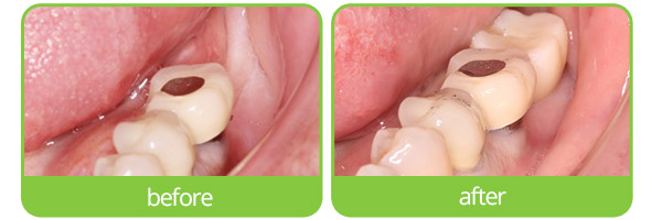 epping dental implants