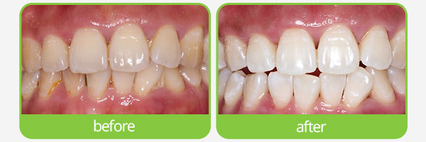 teeth whitening epping 
