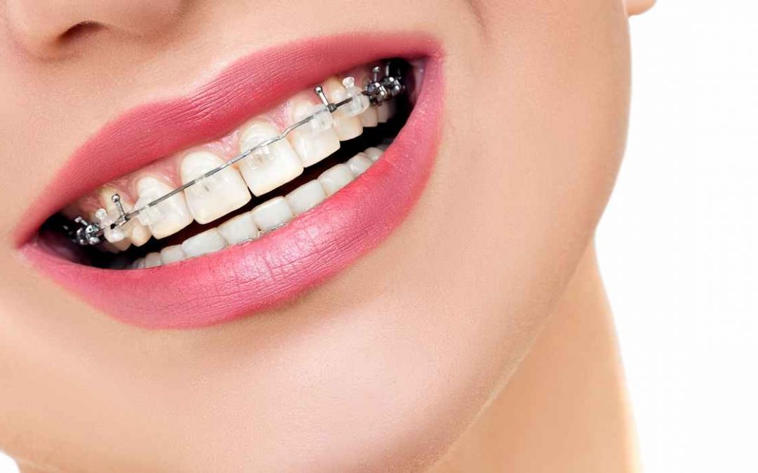 Get The Picture-Perfect Smile With Braces!