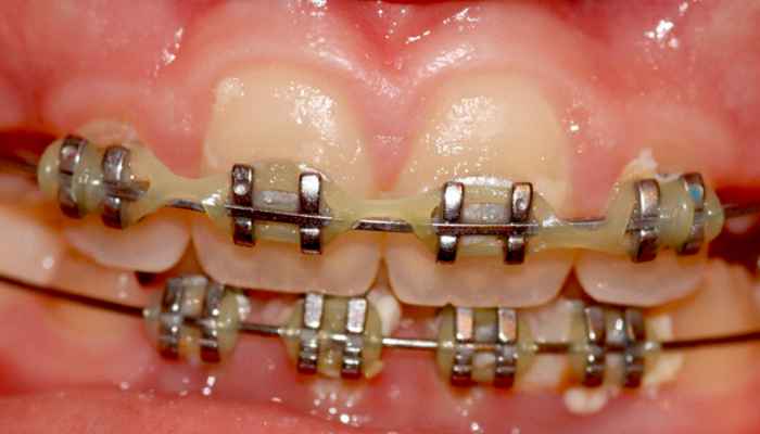 Top Reasons to Choose Metal Braces over Other Orthodontic Treatment Options