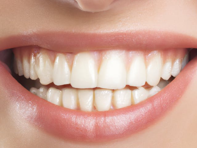 teeth straightening - serenity smiles dental - epping